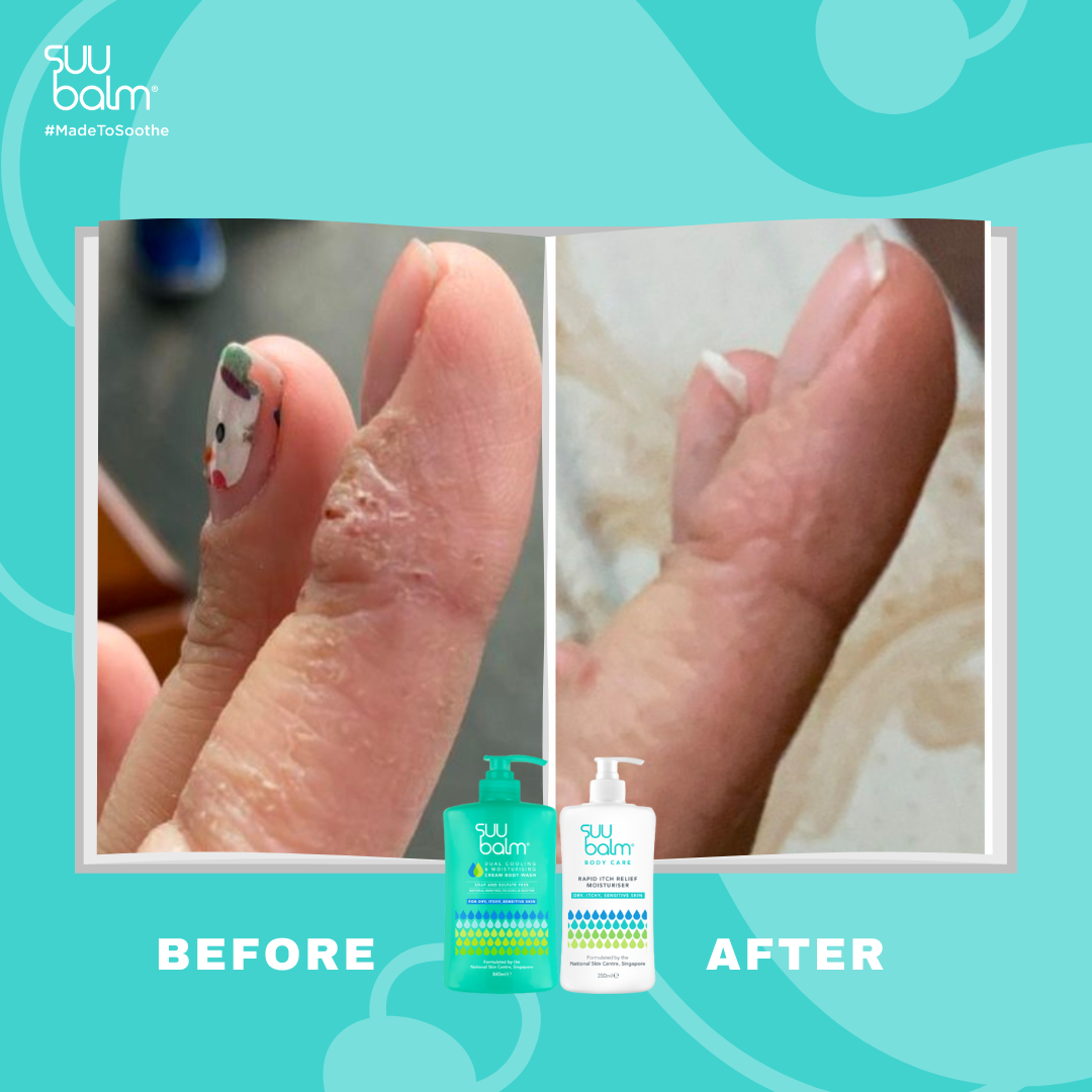 Suu Balm® Rapid Itch Relief Starter Kit