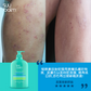 Suu Balm® 終極濕疹優惠套裝A